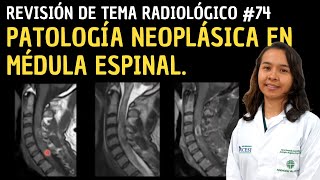 Revisión de tema 74 Patología neoplásica médula espinal [upl. by Anavahs468]