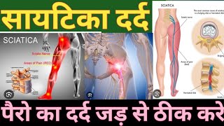 सायटिका दर्द जड़ से ठीक करेहोमियोपैथिक दवा सायटिका कीSciaticaBack painStiffnessArthritis [upl. by Lehcir]