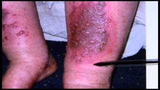 Lymphedema Part 2 [upl. by Walke]