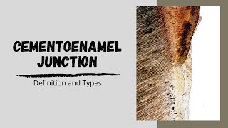 Cementoenamel Junction and its types [upl. by Scever]