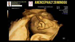 Anencephaly 28 weeks [upl. by Violetta]