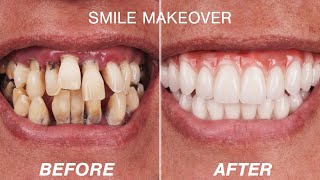 Before amp After Smile Makeover Transformations  Cosmetic Dentistry Dental Boutique [upl. by Hsreh397]