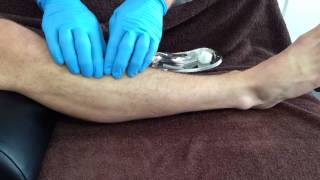 Dry Needling Tibialis Anterior [upl. by Sheppard791]