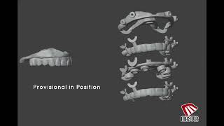 Stackable Implant Surgical guide STL video [upl. by Thedric]