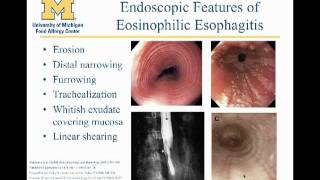 Eosinophilic Esophagitis Matthew Greenhawt MD [upl. by Lareena]