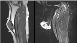 MSKRadiology15caseradiopediafrcrmusculoskeletalmrictxraytipstricksradiantexamsquwstion [upl. by Arva]