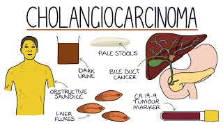 Understanding Cholangiocarcinoma [upl. by Martres]