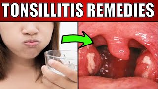 Tonsillitis HOME Remedies and Cures for Fast TREATMENT [upl. by Yrolg]