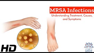 MRSA Unmasked A Comprehensive Guide to Causes Symptoms and Treatment [upl. by Pirali537]