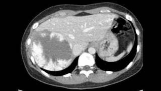 CT interpretation  liver hemangioma [upl. by Arbua]