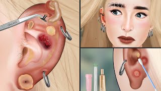 ASMR Remove for Piercing for swollen girls ear  The best care [upl. by Isobel]