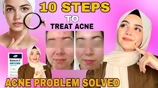 10 Basic Steps To Treat Acne  Acne Treatment At Home  Dietitian Aqsa [upl. by Iggem]