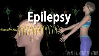 Epilepsy Types of seizures Symptoms Pathophysiology Causes and Treatments Animation [upl. by Cookie]