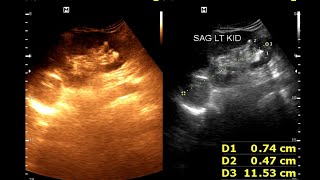 Hydro nephrosis  Renal cortical cyst  Renal calculus [upl. by Webster301]