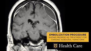 Embolization Procedure Shows Promise as Treatment for Chronic Subdural Hematoma Farhan Siddiq MD [upl. by Socher194]