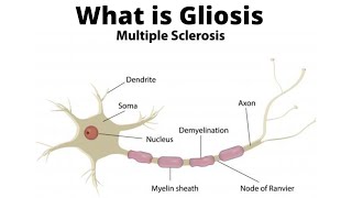 What is Gliosis [upl. by Eeneg]