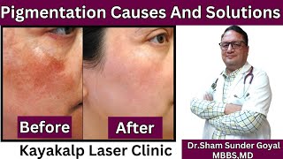 Laser Treatment for Pigmentation Cost in India  Cost of Clear Skin Treatment Laser  Melasma [upl. by Risteau105]