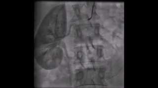 Renal artery angiogram [upl. by Kancler]