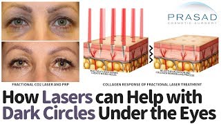 How Under Eye Dark Circles can be Treated with Lasers Plus other Treatments [upl. by Enilesoj]