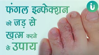 फंगल इन्फेक्शन को जड़ से ख़त्म करने के उपाय  fungal infection ko jad se kaise khatam kare [upl. by Dunning]