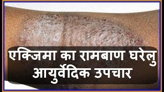 Health Tips एक्जिमा का रामबाण घरेलु आयुर्वेदिक उपचार  Charm Rog  Eczema ka Gharelu Upchar [upl. by Pierce]