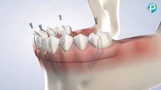 FullArch Restoration in Roseville CA  Placer Oral amp Dental Implant Surgery [upl. by Lubow]