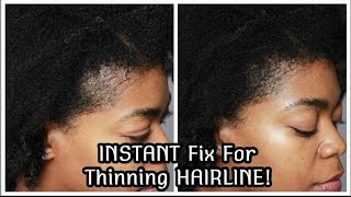 INSTANT Fix For Thinning HairlineEdges Anemia Hair loss Balding Postpartum Toppik  4C Hair [upl. by Lissie195]