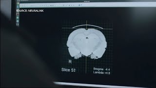 Musk’s Neuralink First Patient Receives Brain Implant [upl. by Adnahsar]