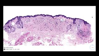 Desmoplastic Trichoepithelioma explained by a dermatopathologist Stain Summary in description [upl. by Silvestro]