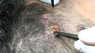 Eliminacion de Nevus Con Láser C02 [upl. by Asek591]