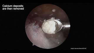 Arthroscopic removal calcific tendonitis [upl. by Natal409]