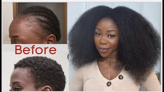 My natural hair journey Hair loss Balding Damage and Regrow  pics and videos [upl. by Yoshi]