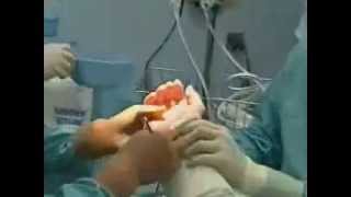 Carpal Tunnel Syndrome  Endoscopic Release Surgery carpal tunnel surgery [upl. by Annette293]