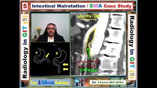 Intestinal malrotation and RLRV Radiology in GIT 5 [upl. by Rachele]