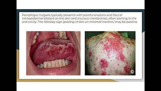 Autoimmune diseases pemphigus vulgaris vs bullous pemphigoid [upl. by Aihsyla]