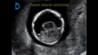 Fetal Medicine Foundation  alobar holoprosencephaly 12 weeks [upl. by Aihseken]