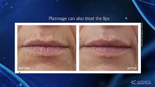 What Is Plasmage®  Introducing Fractional Plasma Technology To Treat Wrinkles amp Other Skin Concerns [upl. by Aisile]