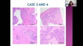 LG PathLab webinars  Salivary gland pathology [upl. by Breanne463]