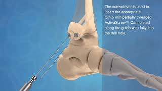 Malleolar and Syndesmosis Fracture Fixation with ActivaScrew™ Cannulated [upl. by Kcirdot]