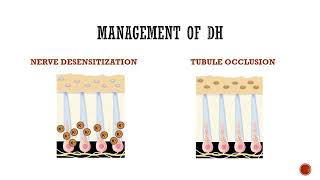 Dentinal Hypersensitivity [upl. by Somerset554]