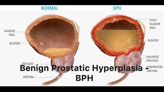 Benign Prostatic Hyperplasia  BPH [upl. by Docile]