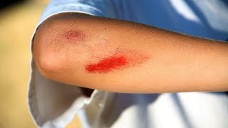 Wound Care 5 Natural Ways To Heal Cuts And Scrapes [upl. by Eecyak]