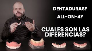 Dentaduras vs Sobre Dentaduras vs Allon4 Implantes Dentales [upl. by Ellednek]