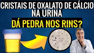 CRISTAIS DE OXALATO DE CÁLCIO na urina aumentam a chance de ter pedras nos rins [upl. by Aisan824]