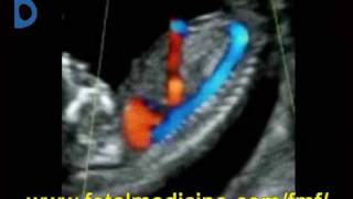 Fetal Medicine Foundation  Ductus venosus [upl. by Nnalatsyrc]