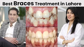 Top 5 Reasons To Get Braces From Dental Aesthetics  Tooth Talk  Dr Shahzad Mirza  Best Dentist [upl. by Eceryt]