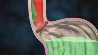 What to do about Acid Reflex GERD GastroEsophageal Reflux [upl. by Selrhc]