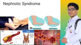 Nephrotic Syndrome  Signs and Symptoms of Nephrotic Syndrome [upl. by Eisor]