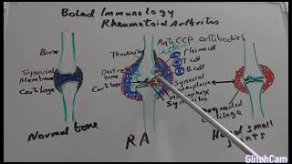 Pathophysiology of Rheumatoid arthritis [upl. by Areyk404]