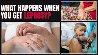 Leprosy Symptoms Types and Whos at Risk Everything You Need to Know [upl. by Yarezed]